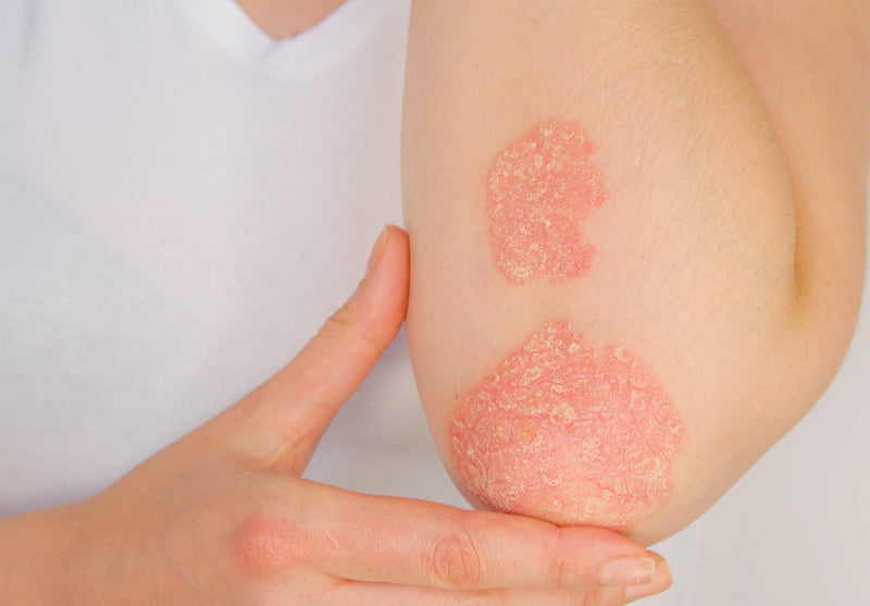 Skincare Routine for Eczema-Prone Skin
