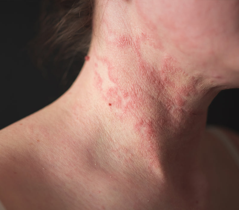 Eczema relief: 5 proven ways to reduce skin eczema.