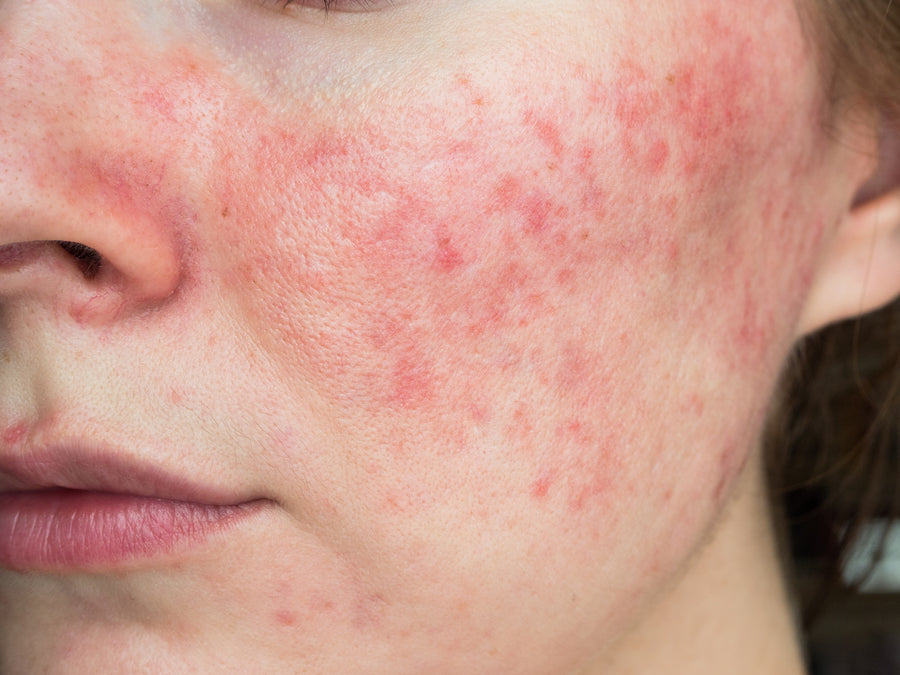 Eczema-prone skin