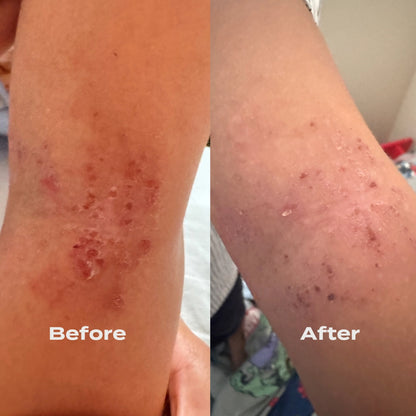 B-Restore Barrier Cream Sensitive Care Pack
