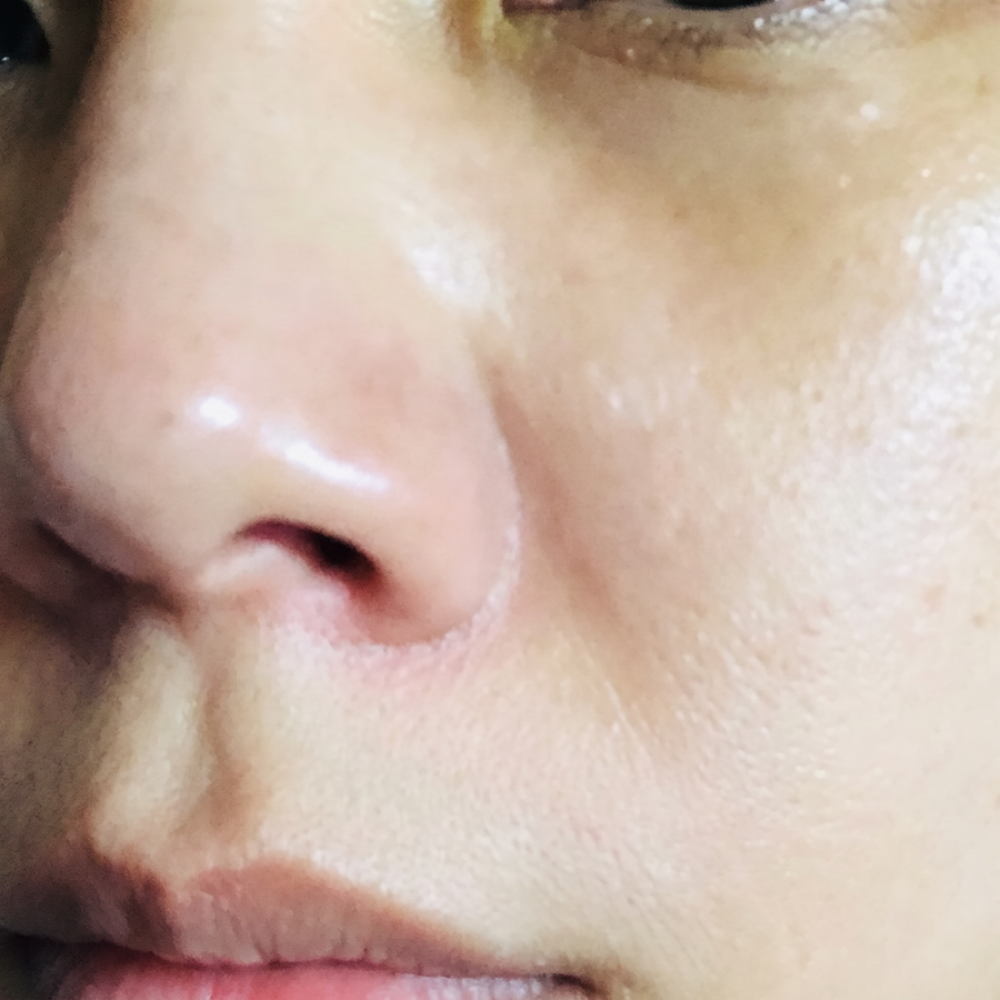 Dry, irritated skin