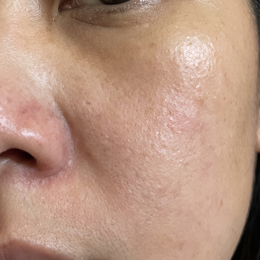 Dry, irritated skin