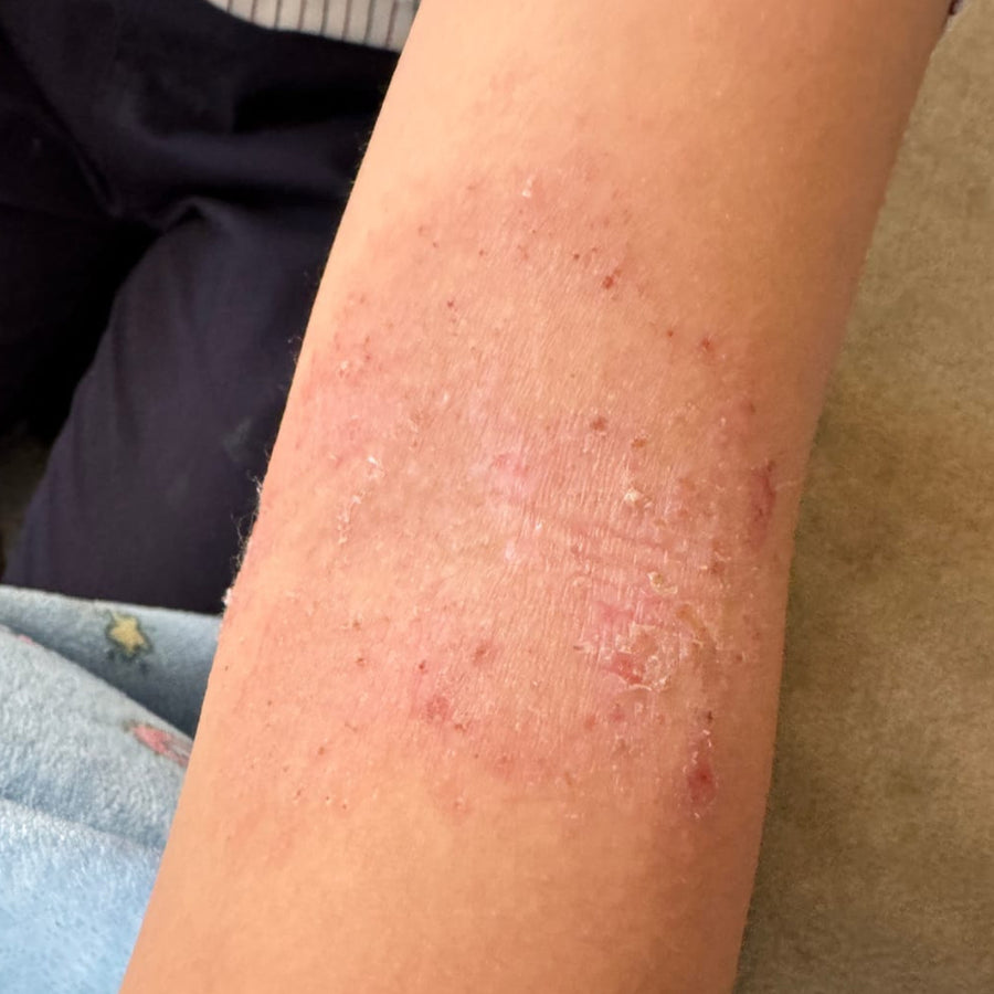 Irritated inner elbow