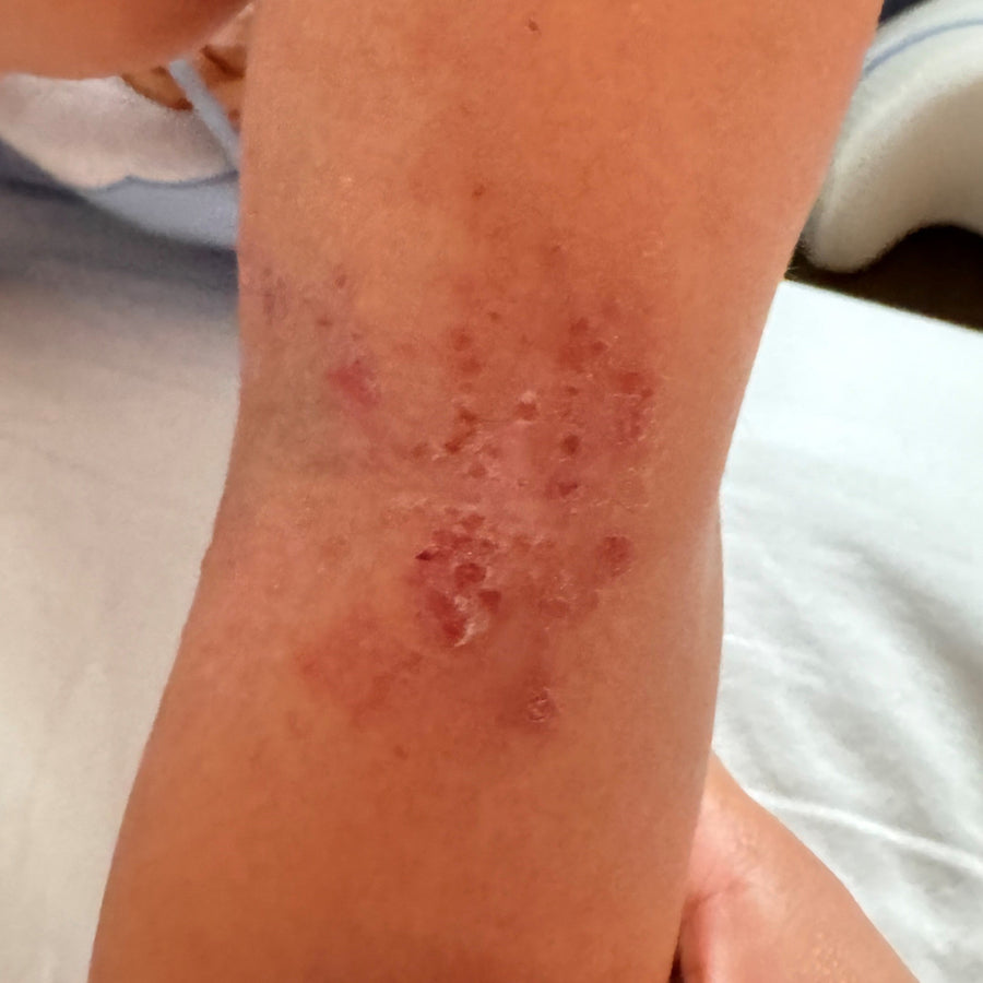 Irritated inner elbow
