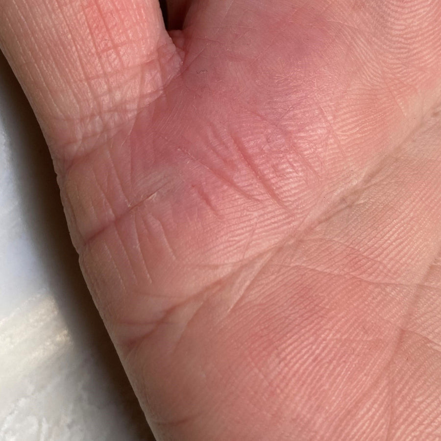 Dry, cracked hands