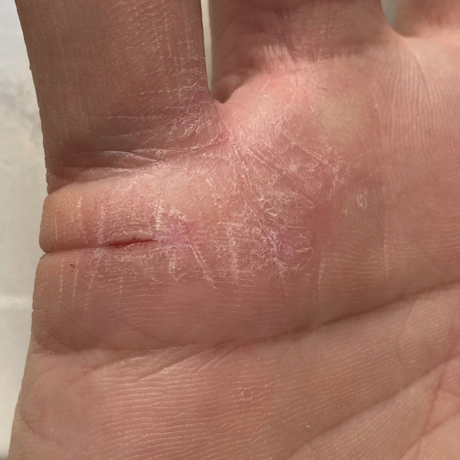 Dry, cracked hands