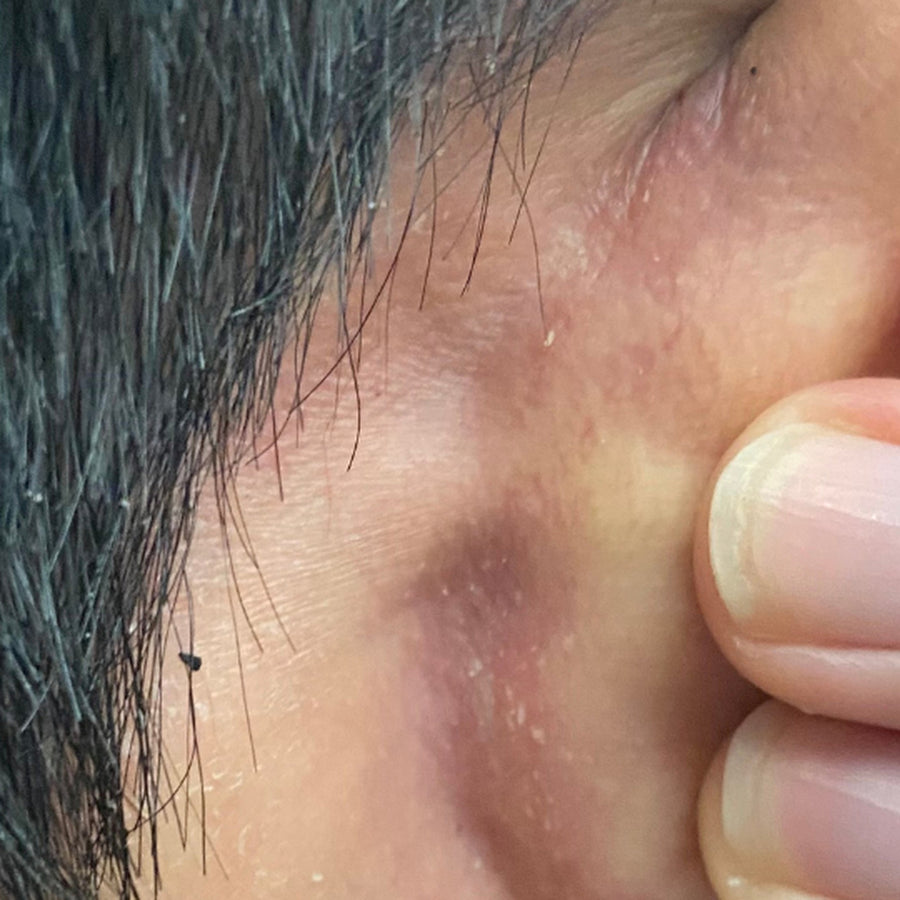 Flaking behind the ear