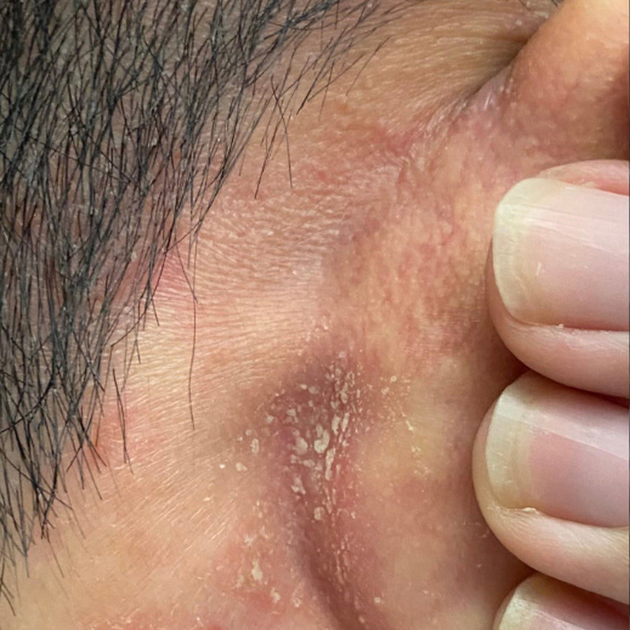 Flaking behind the ear