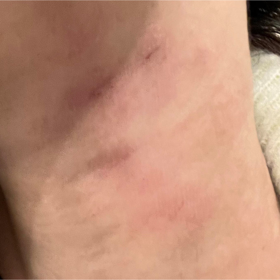 Irritated neck