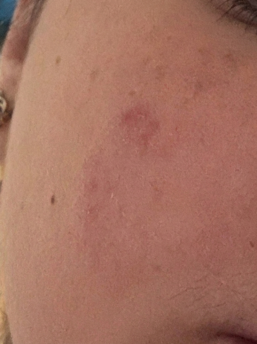 Dry, reactive patches