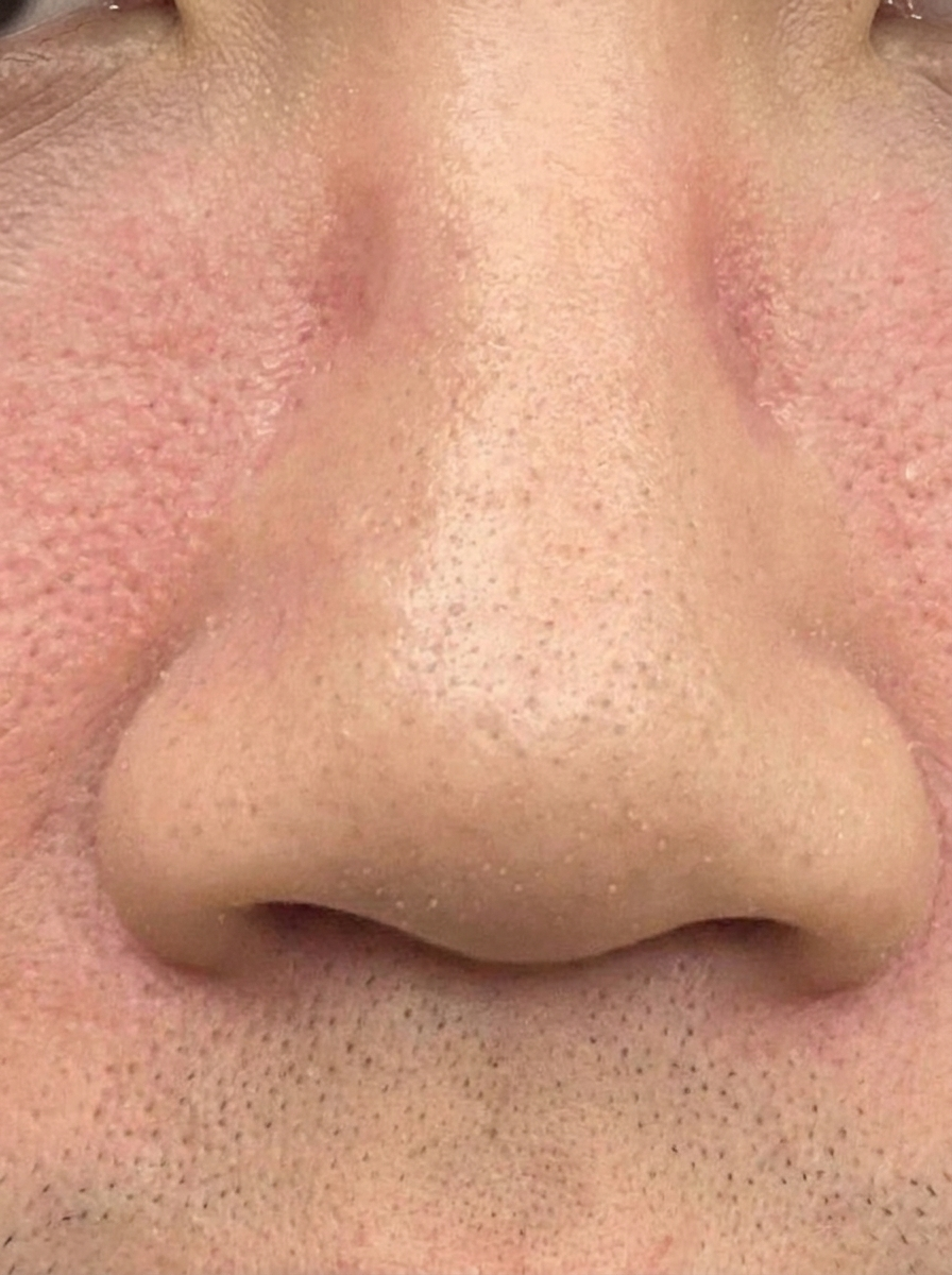 Redness-prone skin