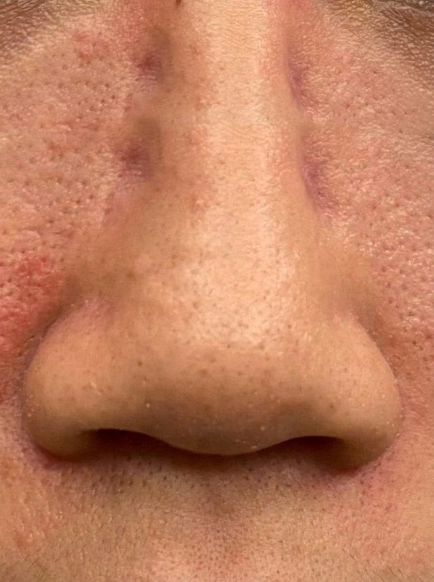 Redness-prone skin