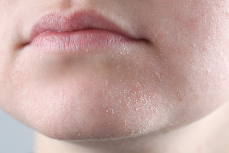 Dry skin